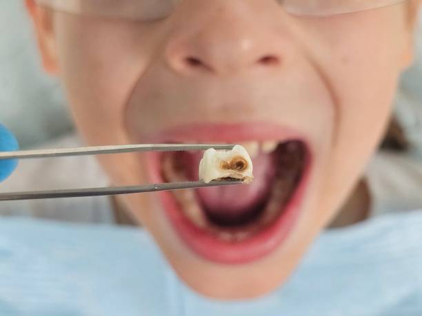 Best Emergency Wisdom Tooth Extraction in Hawthorne, NY